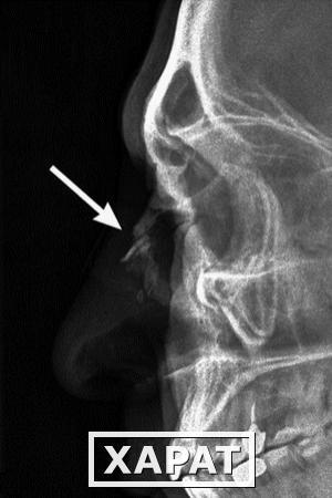 Фото Рентгенография костей носа ( 2 проекции )