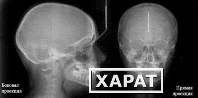 Фото Рентгенография черепа в 2 проекциях