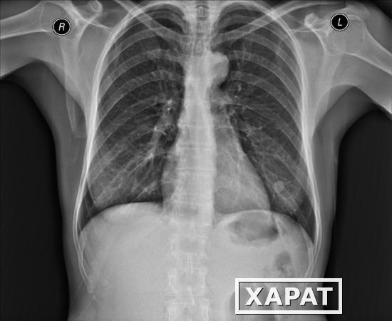 Фото Рентгенография костей предплечья (2 проекции)