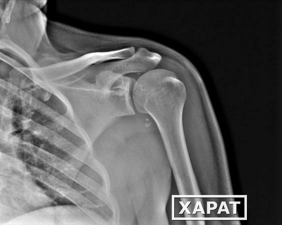 Фото Рентгенография плечевой кости (2 проекции)