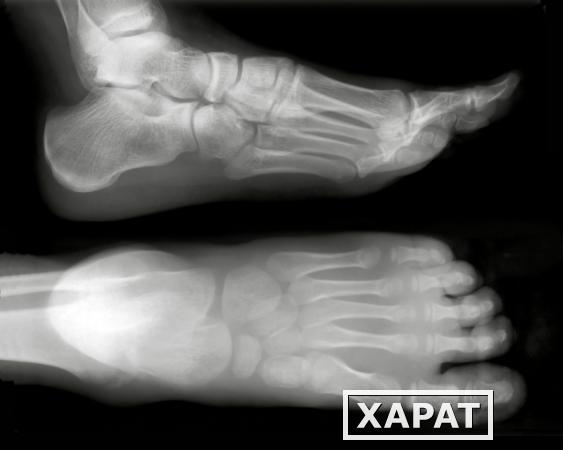 Фото Рентгенография пальцев стопы (2 проекции)