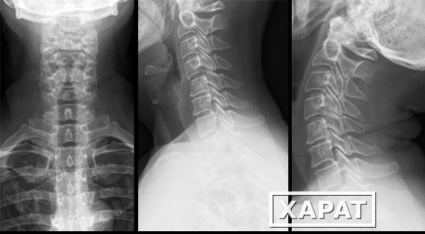 Фото Рентгенография мягких тканей шеи в боковой проекции (выявление инородных тел, ст