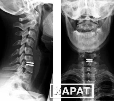Фото Рентгенография шейного отдела позвоночника с функциональными пробами (2 снимка)