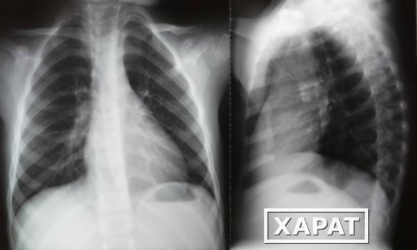 Фото Рентгенография органов грудной полости (2 проекции)