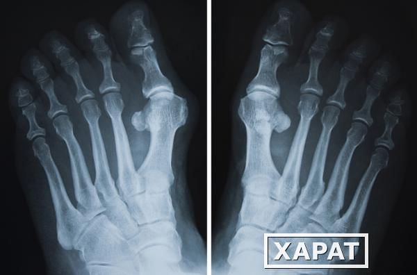 Фото Рентгенография костей стопы (2 проекции)