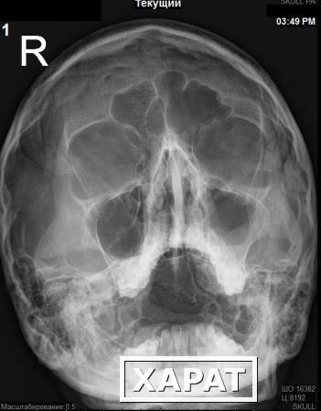 Фото Рентгенография околоносовых пазух (1 проекция)