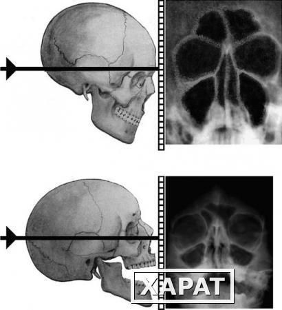 Фото Рентгенография околоносовых пазух (2 проекции)