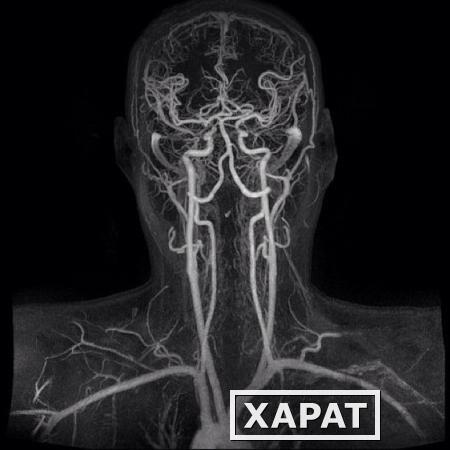 Фото МР-артериография головного мозга