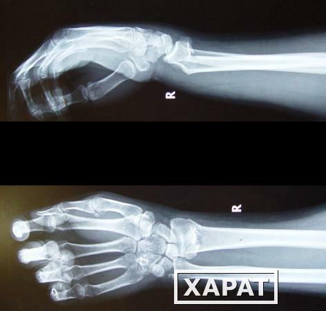 Фото Рентгенография костей кисти (2 проекции)