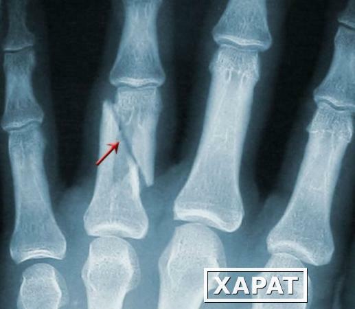 Фото Рентгенография пальцев кисти (2 проекции)