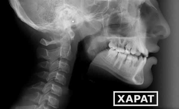 Фото Рентгенография нижней челюсти ( 2 проекции)