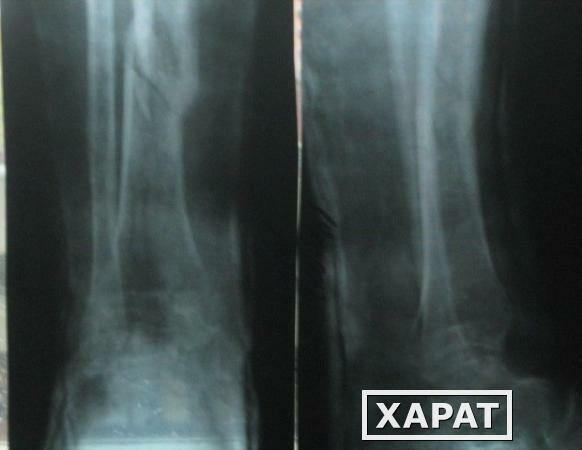 Фото Рентгенография костей голени (2 проекции)