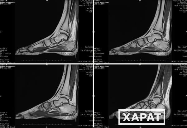 Фото МРТ стопы