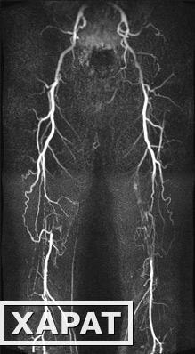 Фото Ангиография сосудов нижних конечностей от бифуркации аорты до коленного сустава
