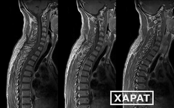 Фото МРТ шейного отдела позвоночника