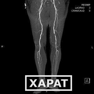 Фото Ангиография сосудов нижних конечностей от бифуркации аорты до стопы