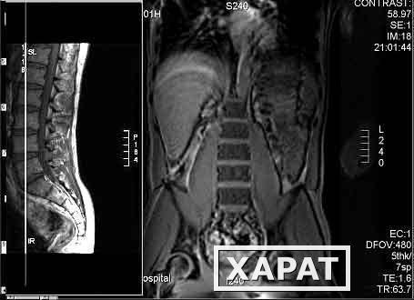 Фото МРТ поясничного отдела позвоночника и крестцово-подвздошных сочленений