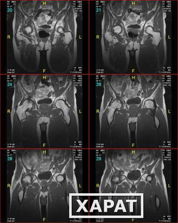 Фото МРТ тазобедренных суставов