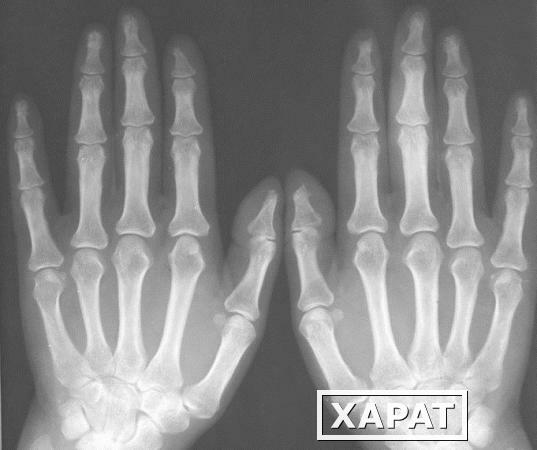Фото Рентгенография обеих кистей (1 проекция)