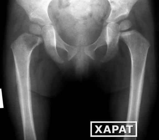 Фото Рентгенография бедренной кости (2 проекции)