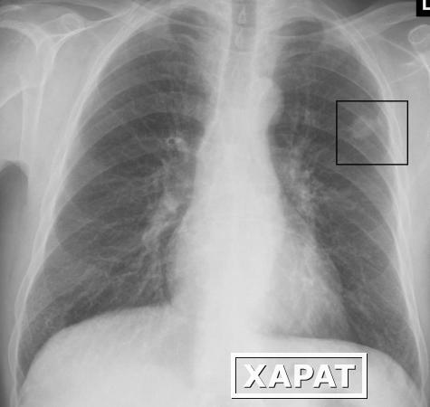 Фото Рентгенография органов грудной полости (1 проекция)