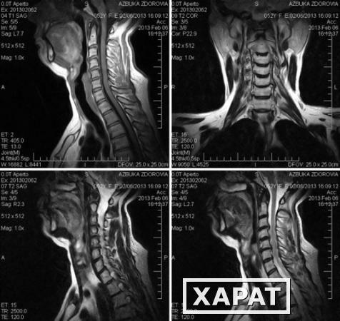 Фото МРТ шейного