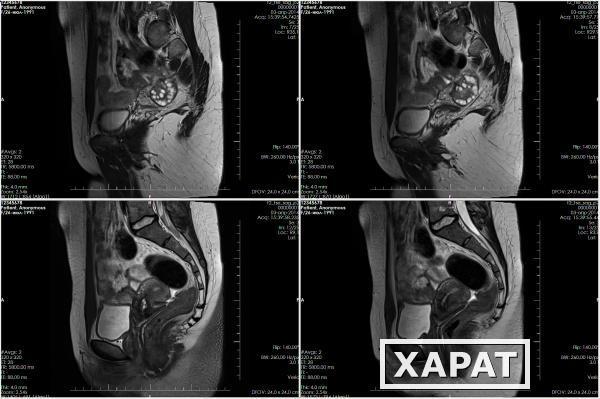 Фото МРТ малого таза