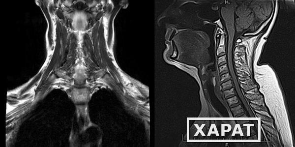 Фото МРТ мягких тканей шеи с измерением голосовой щели и малого язычка верхнего неба