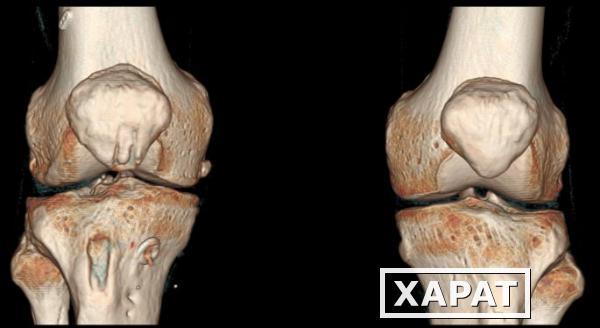 Фото КТ сустава