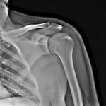 фото Рентгенография плечевой кости (2 проекции)