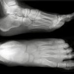 фото Рентгенография пальцев стопы (2 проекции)