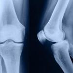 фото Рентгенография коленного сустава (2 проекции)