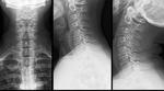 фото Рентгенография мягких тканей шеи в боковой проекции (выявление инородных тел, ст