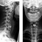 фото Рентгенография шейного отдела позвоночника с функциональными пробами (2 снимка)