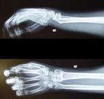 фото Рентгенография костей кисти (2 проекции)