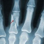 фото Рентгенография пальцев кисти (2 проекции)