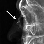 фото Рентгенография костей носа ( 2 проекции )