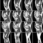 фото МРТ коленного сустава