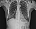 фото Рентгенография костей предплечья (2 проекции)