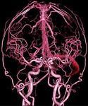 фото КТ-ангиография сосудов головного мозга