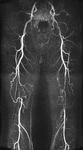 фото Ангиография сосудов нижних конечностей от бифуркации аорты до коленного сустава