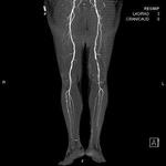 фото Ангиография сосудов нижних конечностей от бифуркации аорты до стопы