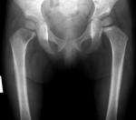 фото Рентгенография бедренной кости (2 проекции)