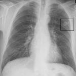 фото Рентгенография органов грудной полости (1 проекция)