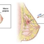 фото Трепан–биопсия молочной железы