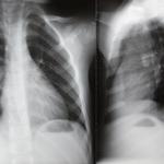 фото Рентгенография органов грудной полости (2 проекции)