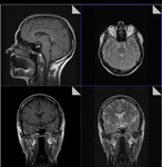 фото МРТ головного мозга