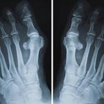 фото Рентгенография костей стопы (2 проекции)