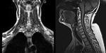 фото МРТ мягких тканей шеи с измерением голосовой щели и малого язычка верхнего неба